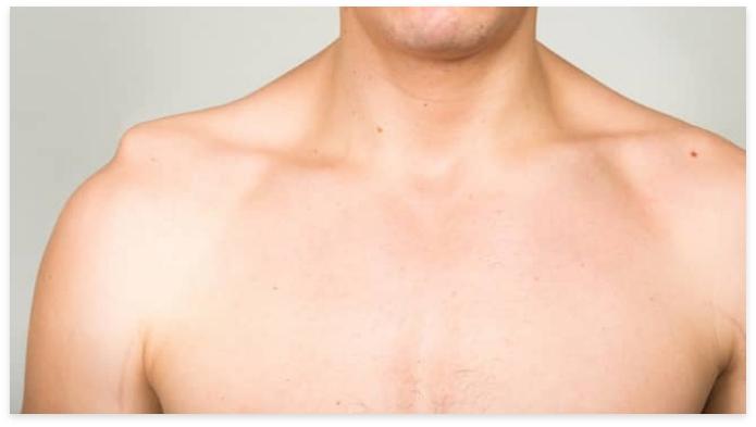 AC Joint Dislocation