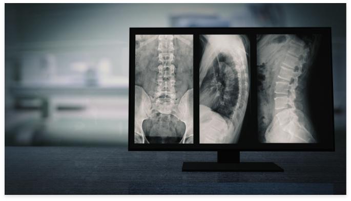 Discectomy Drawbacks